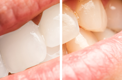 ［画像］歯の黄ばみにはホワイトニング