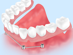 ［画像］インプラントオーバーデンチャー