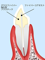 ［画像］ファイバーコアがオススメです