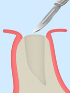 1回法：STEP2