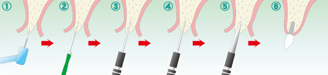 ［画像］なるべく骨を削らなくてすむ「OAM（大口式）インプラント法」02