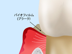 ［画像］軽度の歯周病（歯周炎）