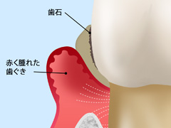 ［画像］中等度の歯周病（歯周炎）