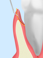 ［画像］歯周ポケット掻爬（そうは）03