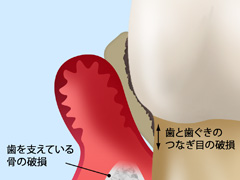 ［画像］重度の歯周病