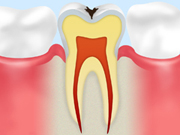 ［画像］C1（エナメル質の虫歯）