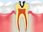 ［画像］C2（象牙質の虫歯）
