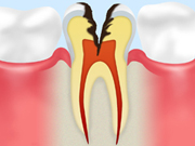 ［画像］C3（神経に達した虫歯）